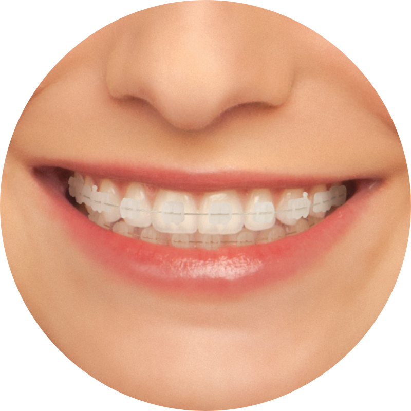 Clear Braces